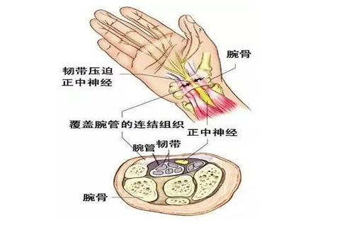 小心折磨人的“鼠标手”，一起了解腕管综合征